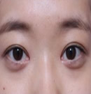 韩国德琳整形外科-双眼皮手术对比日记