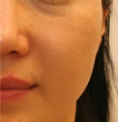 脸部皮肤颜色和毛孔改善术前与术后6个月对比照片_术前