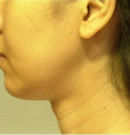 颈部除皱术前与术后两年对比照片_术前