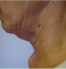 颈部除皱术前与术后7个月对比照片_术前