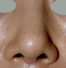 韩国江南三星整形外科-韩国江南三星整形外科钝粗鼻尖整形案例
