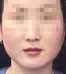 韩国彼岸爱医院注射瘦脸前后对比照片_术前