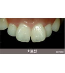 韩国HUSHU牙科皮肤-龅牙矫正手术前后对比照片