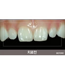 韩国HUSHU牙科皮肤-不美观的牙齿矫正手术前后对比照片
