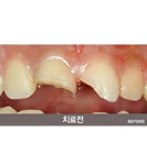 牙齿断裂修复术前后对比照片_术前
