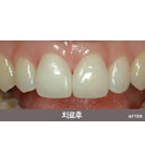 韩国HUSHU牙科皮肤-牙洞修复手术前后对比照片