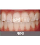 韩国HUSHU牙科皮肤-牙齿美白前后对比照片