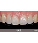 韩国HUSHU牙科皮肤-牙齿大小不整齐矫正术前后对比照片