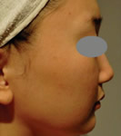激光提升面部皮肤及双下巴前后对比照片