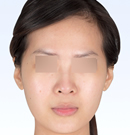 韩国必当归-假体隆鼻手术前后对比图