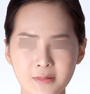 韩国必当归-假体隆鼻手术前后对比图