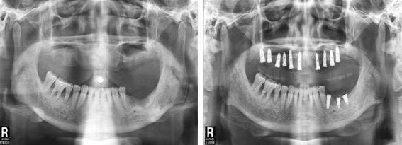 种植牙整形手术前后对比案例