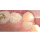 韩国多仁牙科-牙齿修复前后对比图