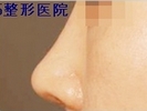 韩国博士75整形-鼻头鼻尖整形手术前后对比照片