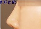 韩国博士75整形-鼻头整形手术前后对比照片