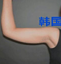 韩国博士75整形-手臂吸脂整形手术前后对比照片