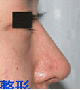 韩国博士75整形-鼻部综合整形手术对比照片