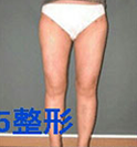 韩国博士75整形-大腿吸脂整形手术前后对比照片