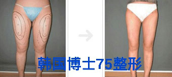 大腿吸脂整形手术前后对比照片