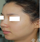 韩国青春整形外科-隆鼻失败修复前后对比图