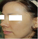 韩国青春整形外科-鼻头鼻尖整形手术前后对比照片