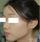 韩国青春整形外科-鼻部整形前后对比照片