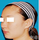 韩国青春整形外科-隆鼻前后对比照片