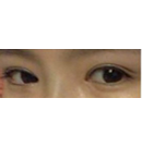 韩国青春整形外科-珍珠双眼皮手术前后对比图