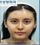 韩国珠儿丽-面部整形手术对比照