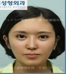 韩国珠儿丽-面部整形手术对比案例