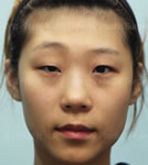 韩国珠儿丽-韩国珠儿丽整形外科大小眼矫正前后对比照片