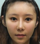 韩国珠儿丽整形外科大小眼矫正前后对比照片_术后