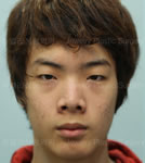 韩国珠儿丽-韩国珠儿丽医院男士眼鼻整形前后对比照片