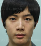 韩国珠儿丽-韩国珠儿丽医院男士眼鼻整形前后对比照片