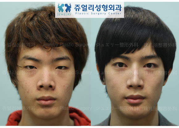 韩国珠儿丽医院男士眼鼻整形前后对比照片