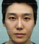 韩国珠儿丽整形外科男士面部手术案例图_术后