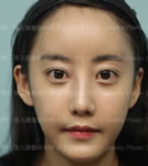 韩国珠儿丽医院面部整形手术前后对比照片_术后