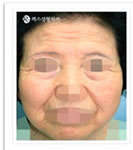 韩国REX整形外科-整体面部拉皮手术