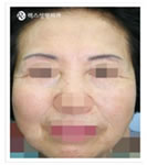 韩国REX整形外科-整体面部拉皮手术
