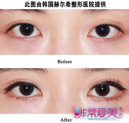 韩式双眼皮手术前后对比照片