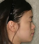 韩式隆鼻手术案例对比照片_术前