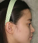 韩式隆鼻手术案例对比照片