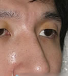 驼峰鼻矫正手术对比照片