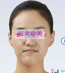 韩国ID整形外科面部反颌整形手术对比案例