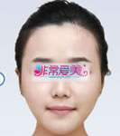 韩国ID整形外科下颌角整形手术对比案例_术后