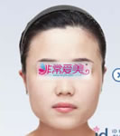 韩国ID整形外科下颌角整形手术对比案例_术前