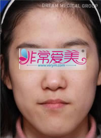 韩国德琳整形外科-下颌角整形手术对比案例