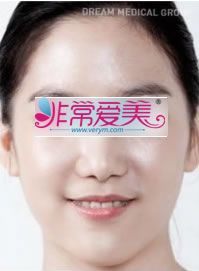 韩国德琳整形外科-下颌角整形手术对比案例