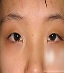 双眼皮手术案例对比照_术前