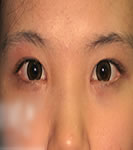 双眼皮手术案例对比照